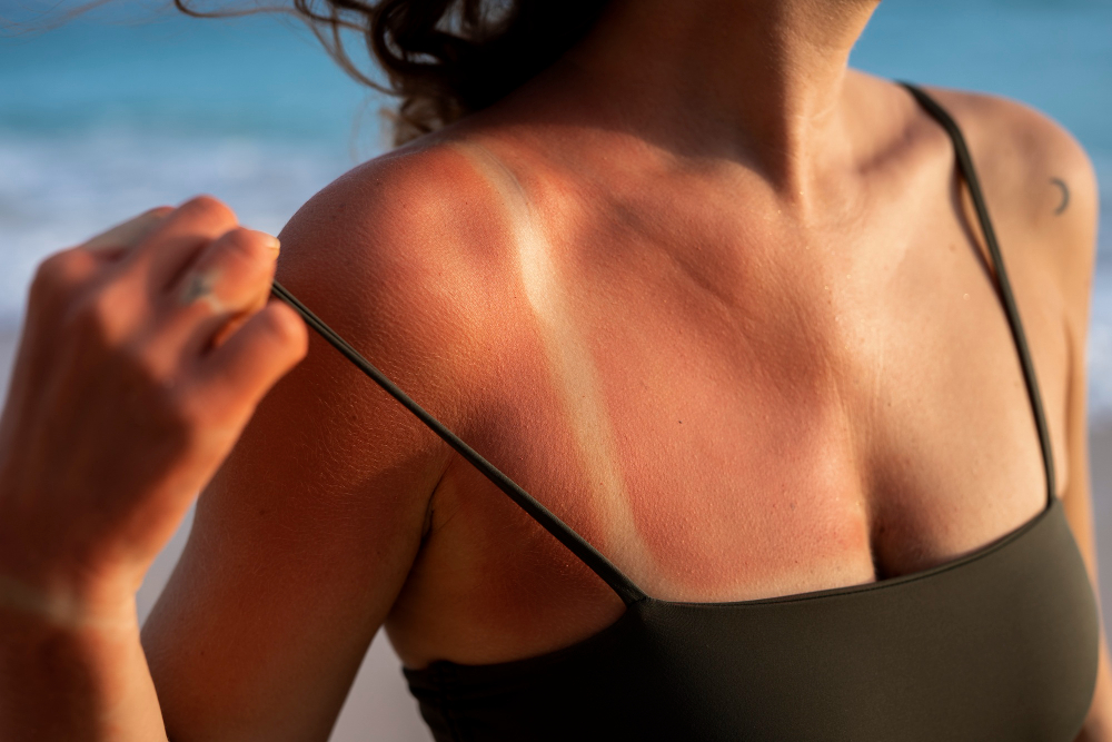 Cum îți afectează pielea bronzul obținut la solar