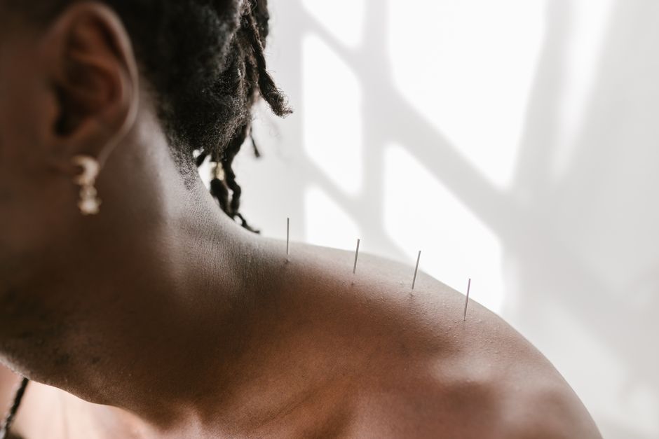 Tratament acupunctura