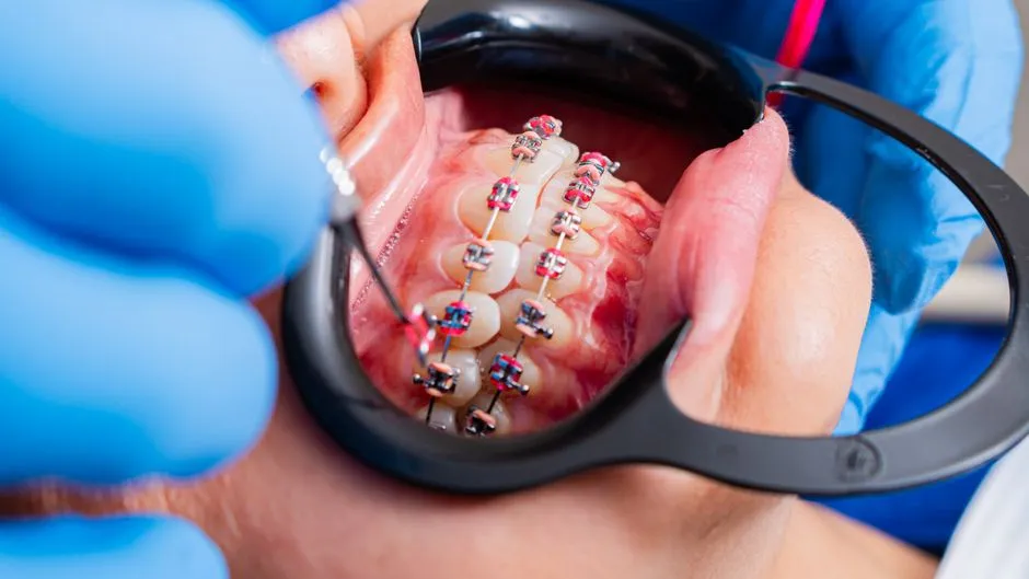 Aparatele dentare: cum functioneaza ortodontia moderna — Clinica Online
