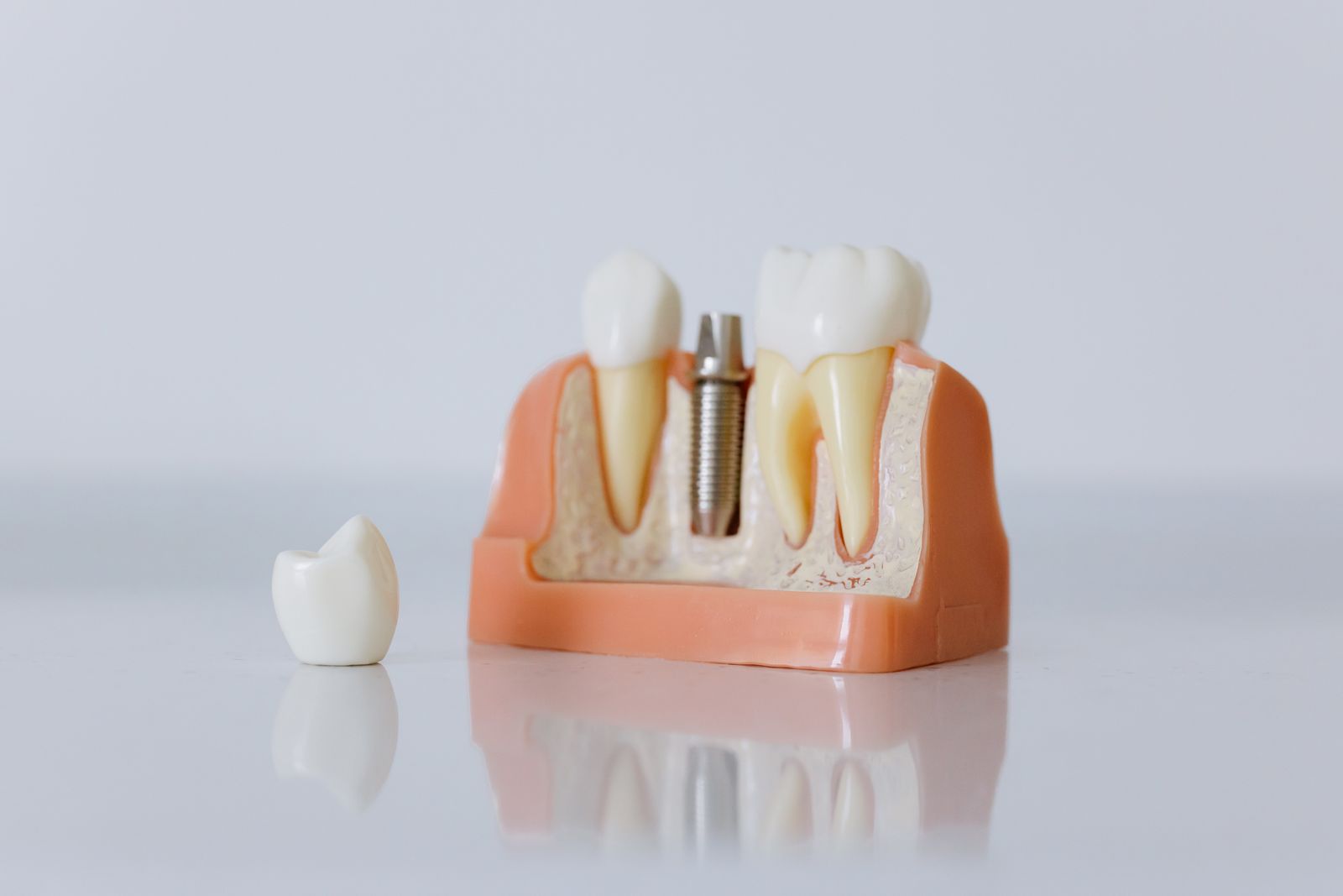 Ți-ai pierdut un dinte? Cum se înlocuiește corect, explicat de specialiștii Upgrade Dental