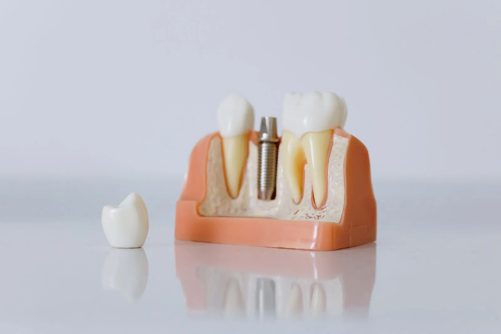 Ți-ai pierdut un dinte? Cum se înlocuiește corect, explicat de specialiștii Upgrade Dental